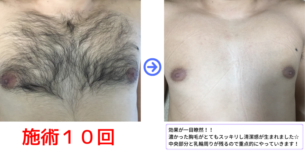 K様の胸脱毛のビフォーアフターです